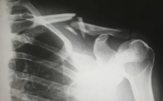 X-ray of shoulder showing bones and joints with regard to shoulder tension- Angel Chiropractic shoulder care